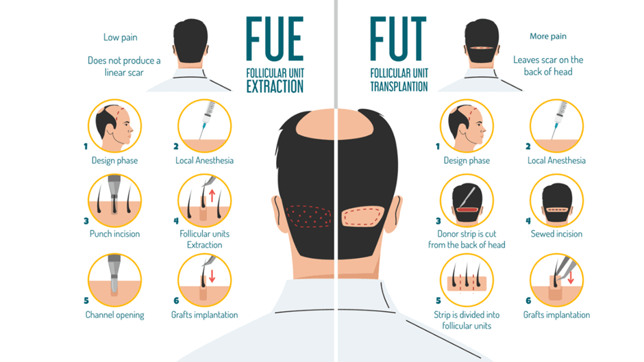Differences Between FUE VS FUT