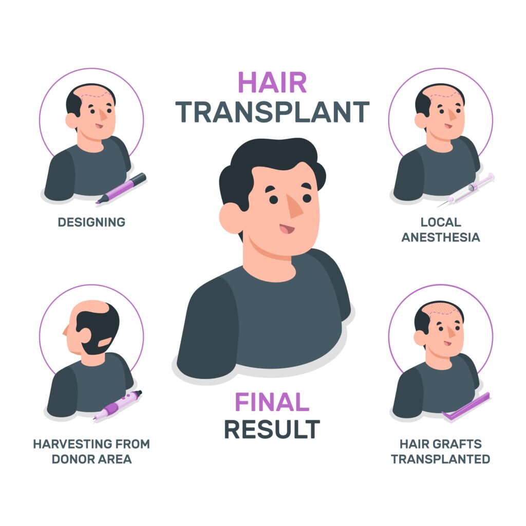 Hair Transplant Result