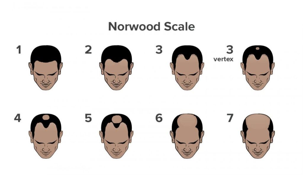 Male Pattern Baldness Stages