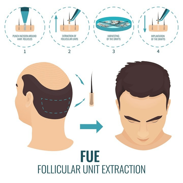 FUE Hair Transplant Cost in India