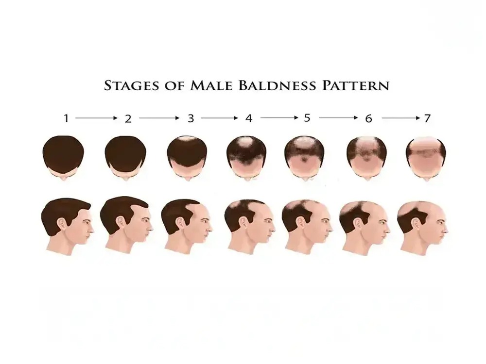 Male Pattern Baldness Stages