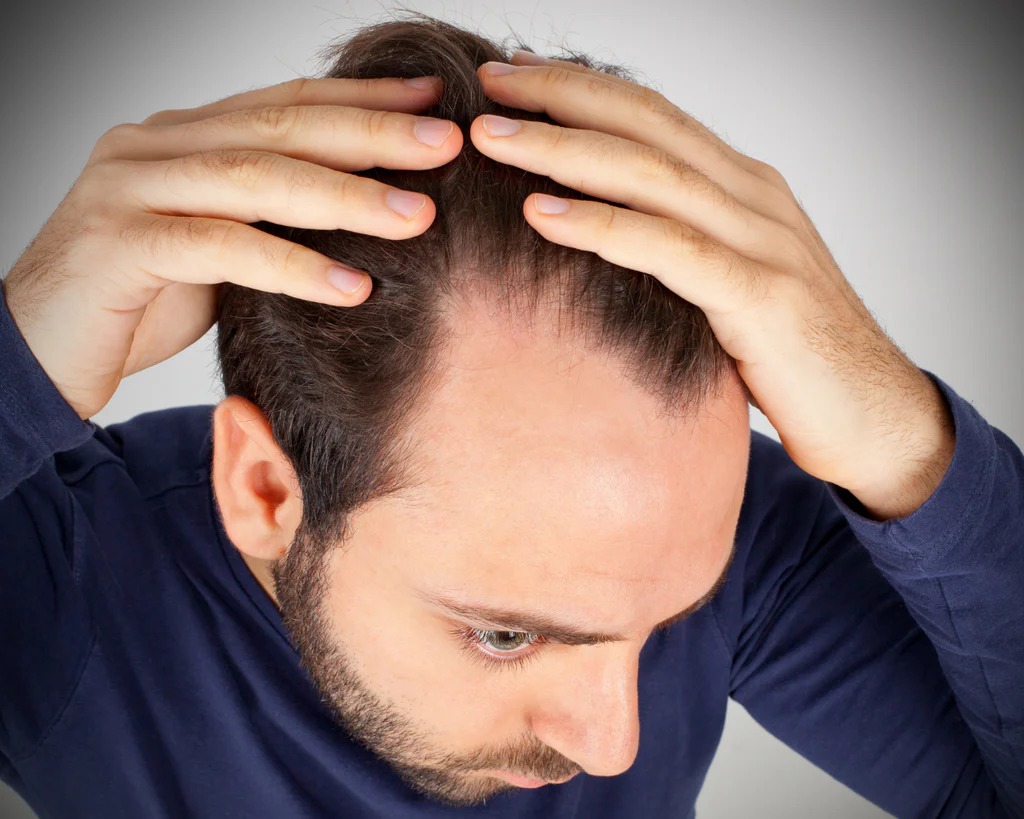 Causes of Male Pattern Baldness