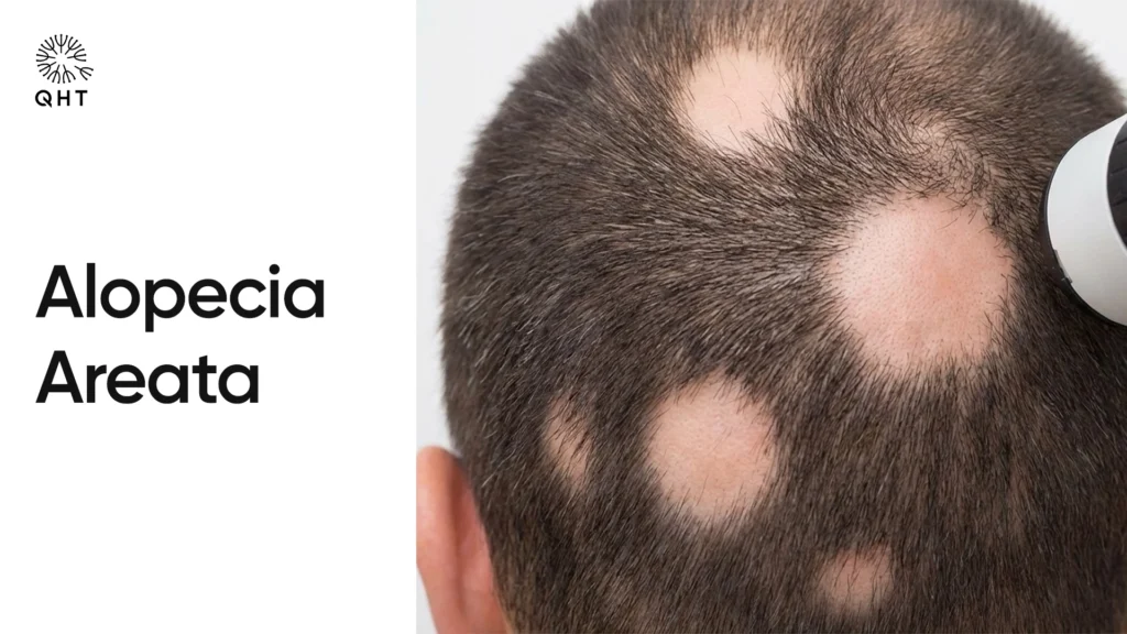 Circular bald patches on a person's scalp, a classic symptom of the autoimmune disorder Alopecia Areata.
