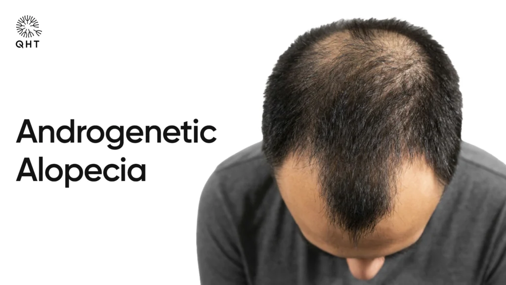 Top view of a man showing signs of androgenetic alopecia and thinning hair at the crown.
