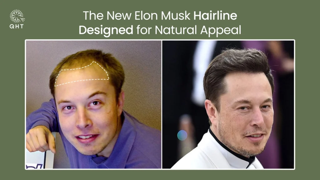 Elon Musk hairline natural appeal before and after comparison