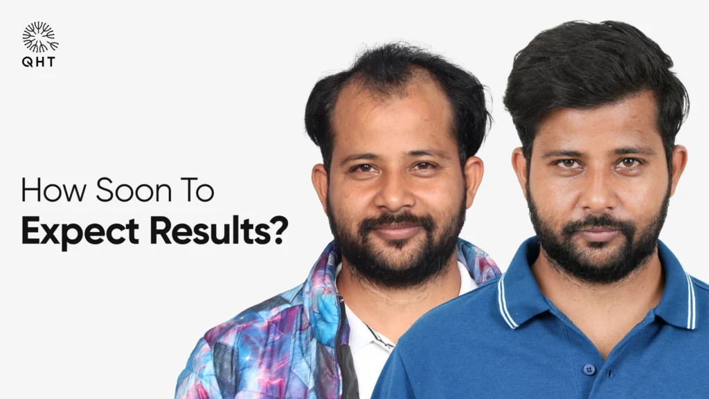 A side-by-side comparison of two men showing hair growth progress with the question "How Soon To Expect Results?" to illustrate post-transplant density.