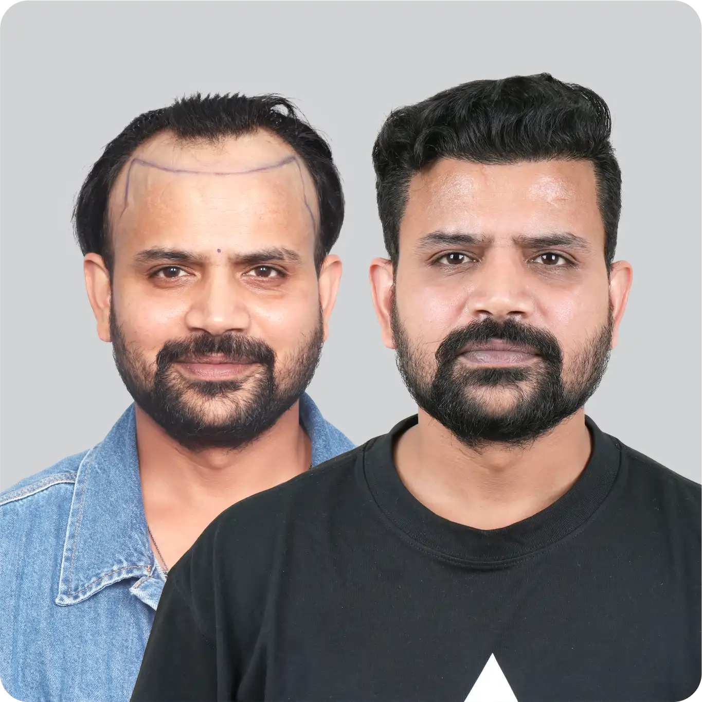Safe Hair Transplant