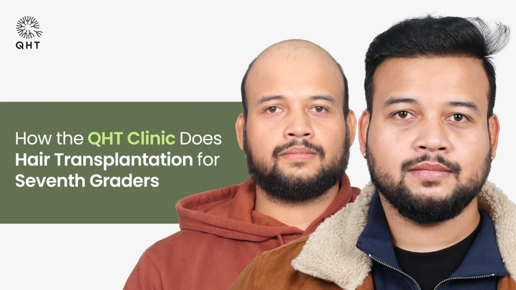 Before and after photos of a patient showing significant coverage improvement after a Grade 7 hair transplant.