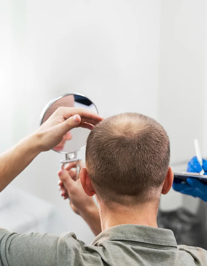 Understanding Crown Baldness