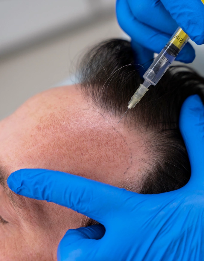 Best Age for a Hair Transplant in Delhi