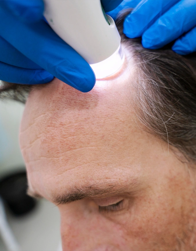 Understanding Hair Transplant Repair in Delhi