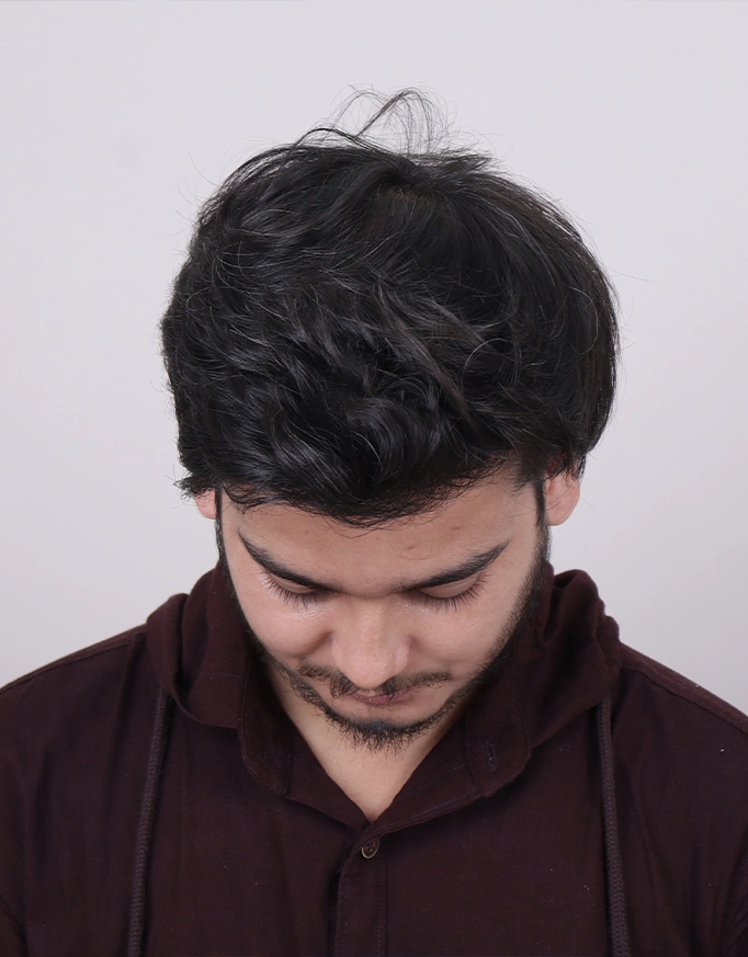 What Happens If You Get a Hair Transplant Too Early?