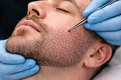 Facial hair transplant