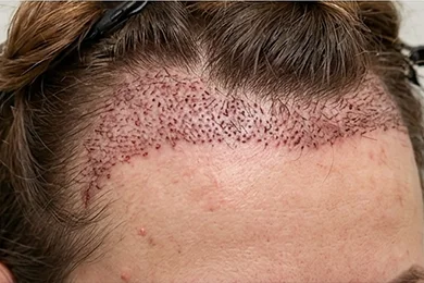 Personalised Hairline Design
