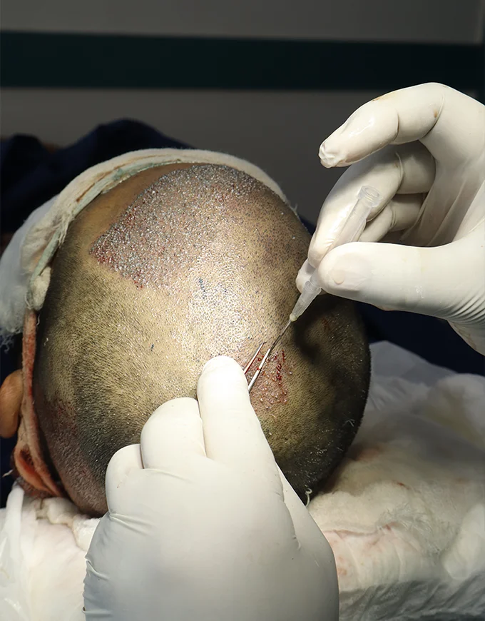 Crown Hair Transplant Procedure at QHT Gurgaon