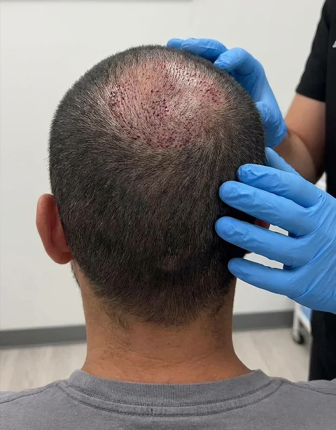 Recovery After Crown Hair Transplant