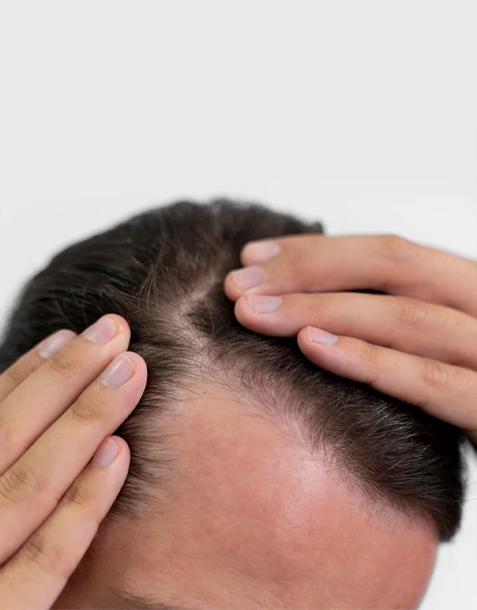Am I a Good Candidate for Hair Transplant?
