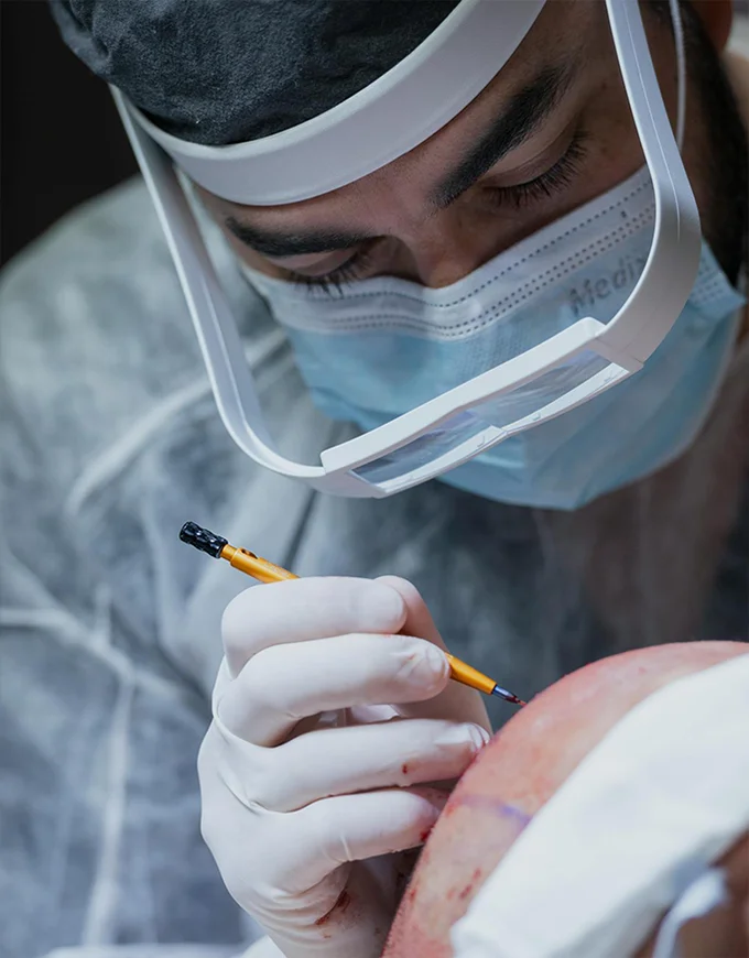 How to Choose a Qualified Hair Transplant Surgeon